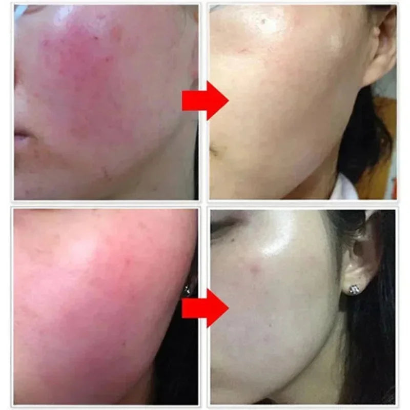 Facial Redness Repair Cream Improve Sensitive Skin Dryness Moisturizer Hydrating Sooth Lotion Removal Rosacea Korean Cosmetics