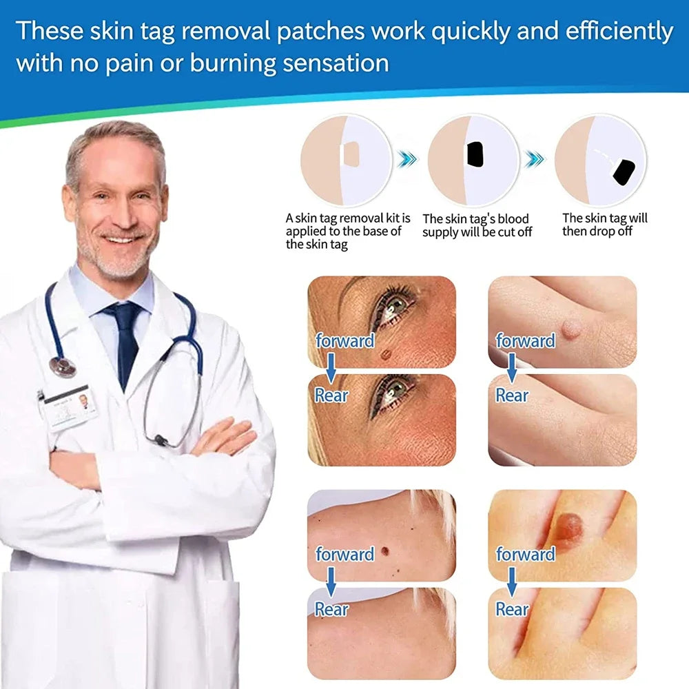 2 IN 1 Auto Micro Skin Tag Remover Device Standard And Micro Skin Tag Removal Kit Adult Mole Wart Remover Face Care Beauty Tools
