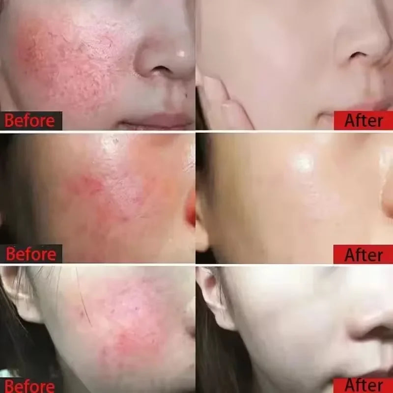 Facial Redness Repair Capsule Oil Improve Sensitive Skin Dryness Moisturizer Soothing Serum Removal Rosacea Korean Cosmetics