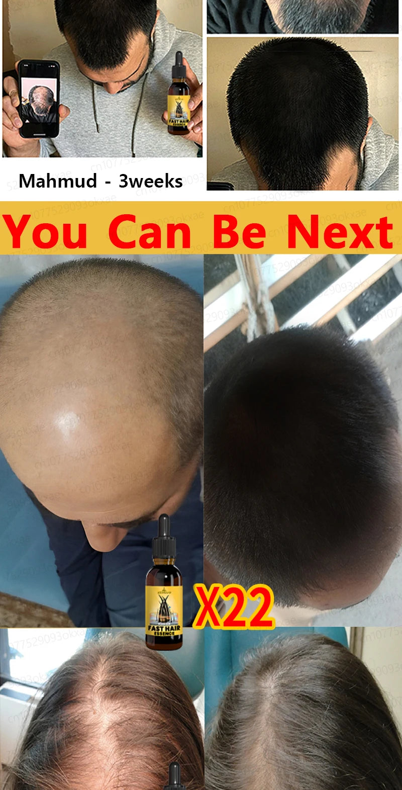 hair growth oil, Repair baldness, hairline, seborrheic alopecia hair care  fast shipping  hair oil