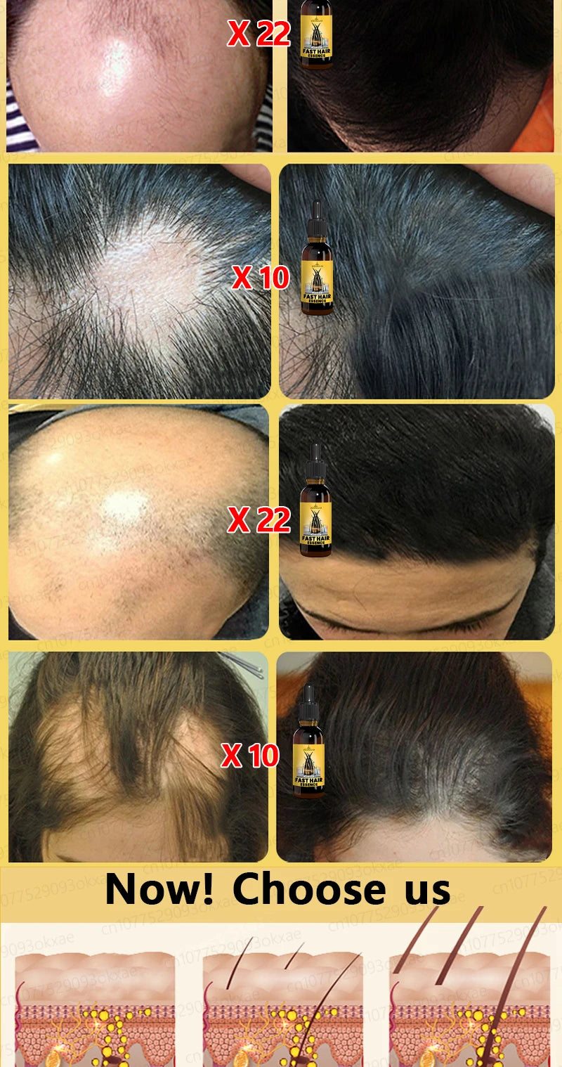 hair growth oil, Repair baldness, hairline, seborrheic alopecia hair care  fast shipping  hair oil