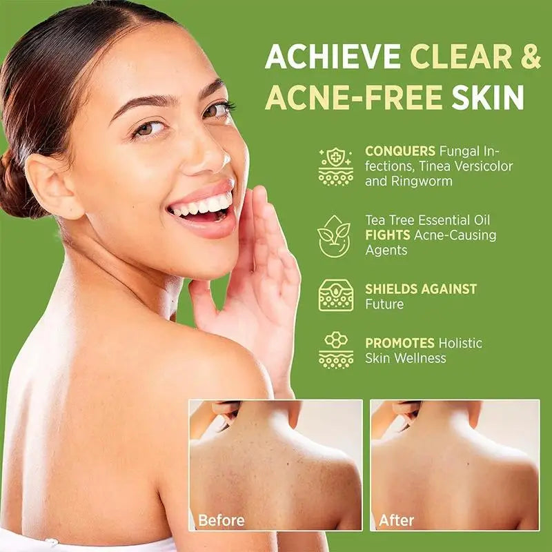 Tea Tree Soap for Face & Body Acne, 100g Tea Tree Oil Soap Bar for Face & Body Natural Skin Cleanser for Oily, Dry & Itchy Skin