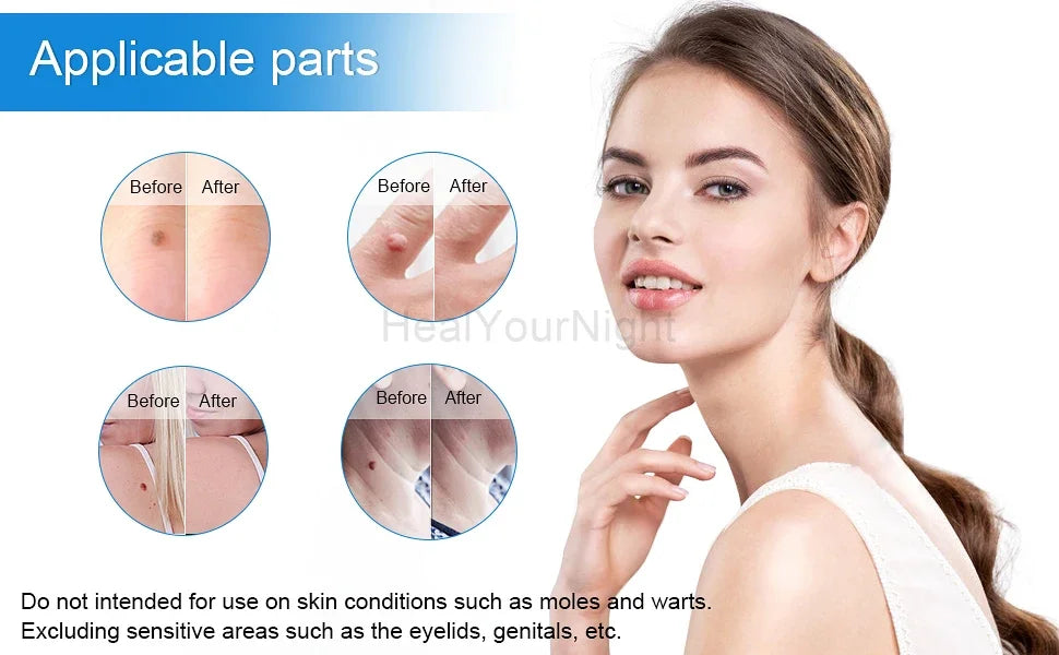 3 IN 1 Auto Micro Skin Tag Remover Device Standard And Micro Skin Tag Removal Kit Adult Mole Wart Remover Face Care Beauty Tools
