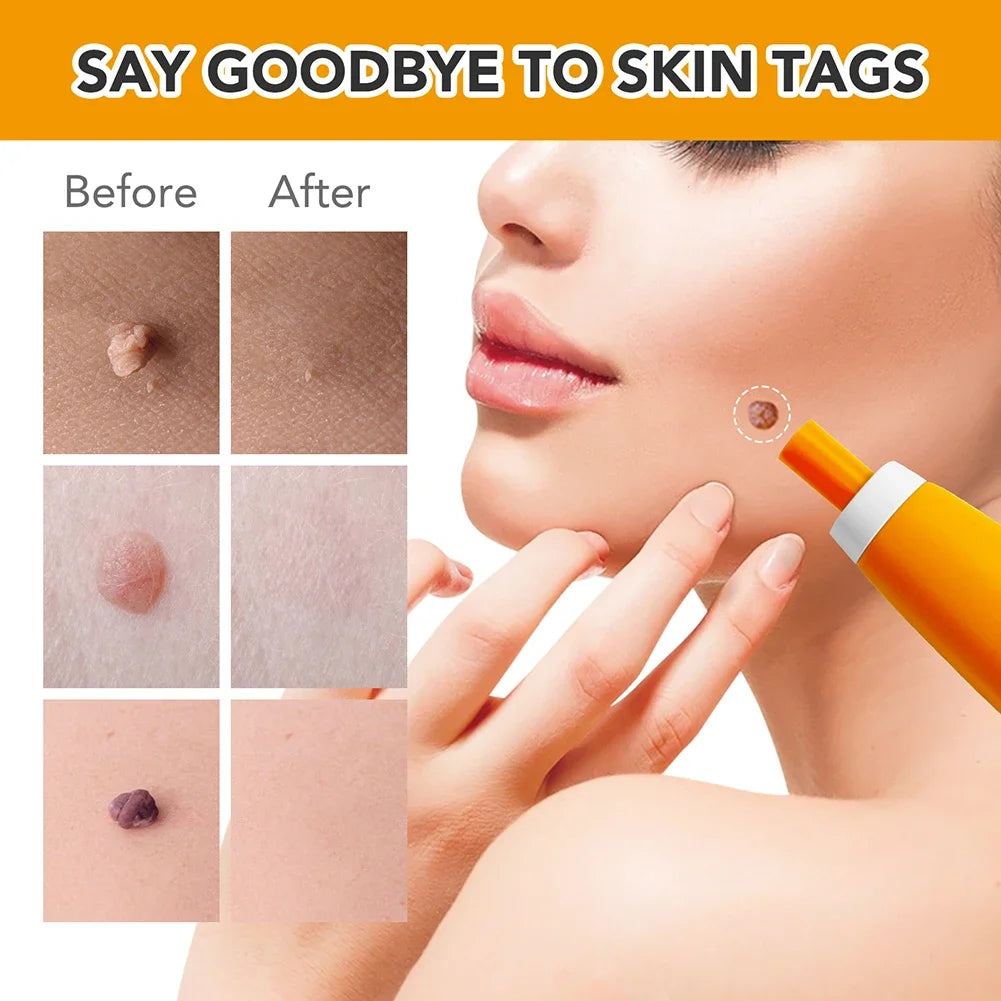 2 IN 1 Auto Micro Skin Tag Remover Device Standard And Micro Skin Tag Removal Kit Adult Mole Wart Remover Face Care Beauty Tools