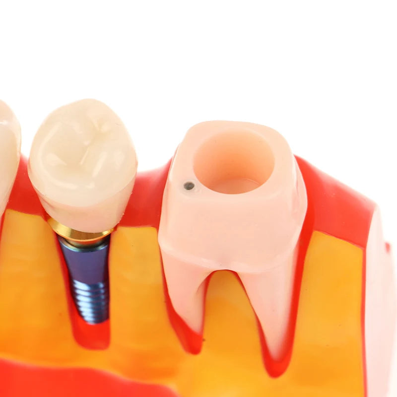 Dental 4 Times Implant Teeth Model Analysis Crown Bridge Demonstration Removable Model Dentistry Study Training Teaching Model