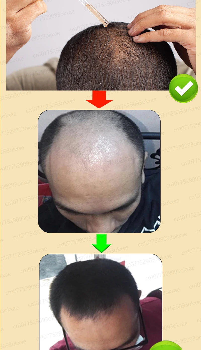 hair growth oil, Repair baldness, hairline, seborrheic alopecia hair care  fast shipping  hair oil