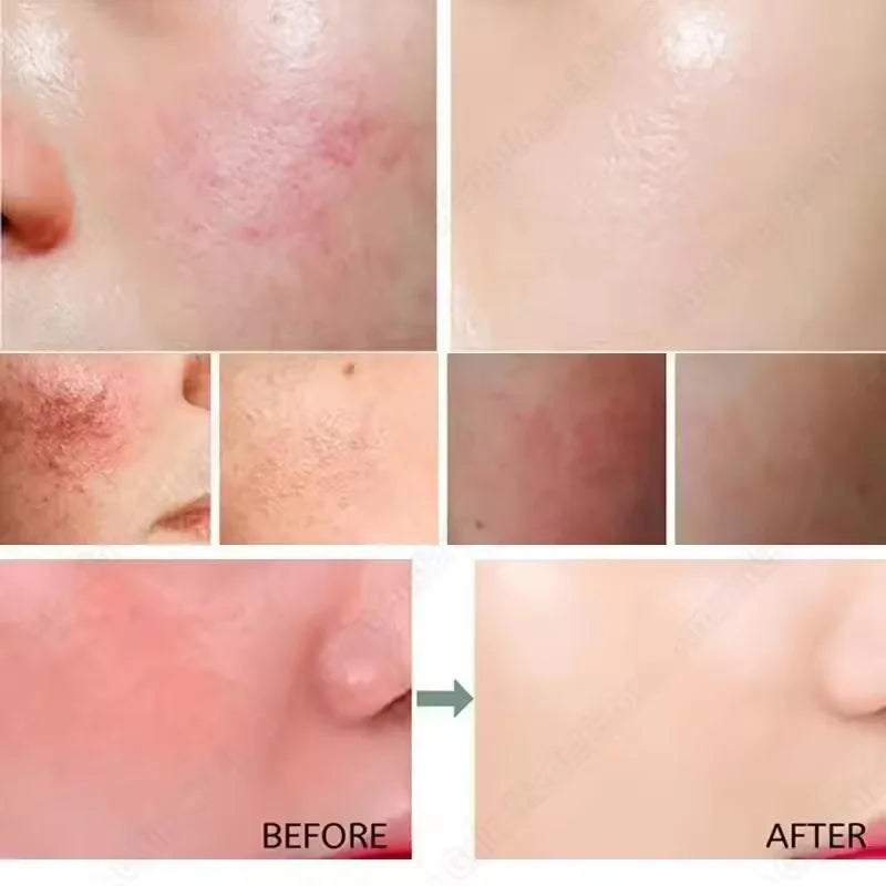Facial Redness Repair Capsule Oil Improve Sensitive Skin Dryness Moisturizer Soothing Serum Removal Rosacea Korean Cosmetics