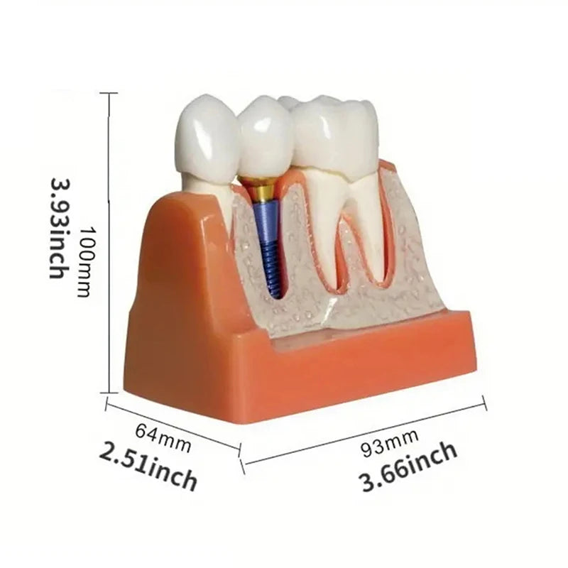 Dental 4 Times Implant Teeth Model Analysis Crown Bridge Demonstration Removable Model Dentistry Study Training Teaching Model