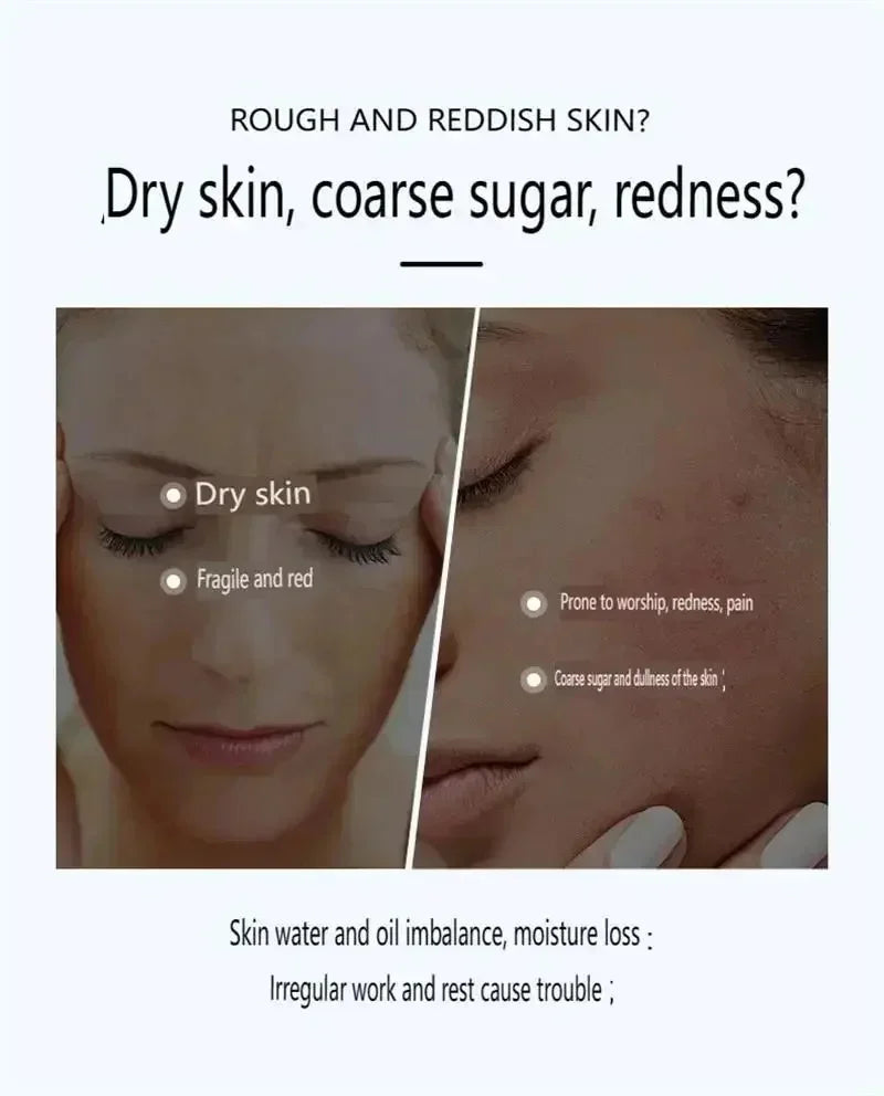 Facial Redness Repair Cream Improve Sensitive Skin Dryness Moisturizer Hydrating Sooth Lotion Removal Rosacea Korean Cosmetics